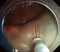 オリンパス：送液機能付きディスポーザブル高周波ナイフ DualKnife J　デバイス交換なしで 粘膜下層へのナイフ送液が可能