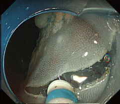 オリンパス：送液機能付きディスポーザブル高周波ナイフ DualKnife J　デバイス交換なしで 粘膜下層へのナイフ送液が可能