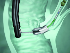 オリンパス：ディスポーザブルバルーンダイレータ（ナイフ付） StoneMaster V　ESTナイフとEPLBD・EPBDバルーンを 組み合わせた2 in 1デバイス