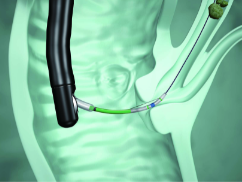 オリンパス：ディスポーザブルバルーンダイレータ（ナイフ付） StoneMaster V　ESTナイフとEPLBD・EPBDバルーンを 組み合わせた2 in 1デバイス