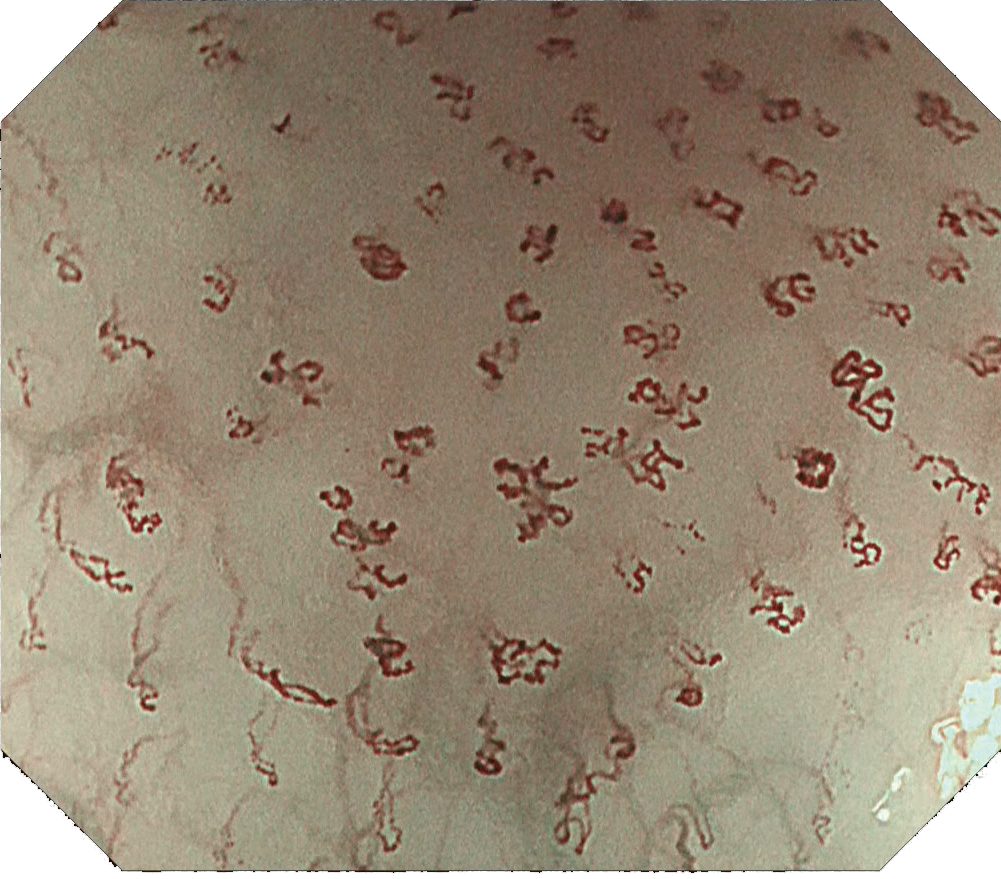 オリンパス：上部消化管汎用ビデオスコープ  GIF-H290EC　EC-NBI観察画像