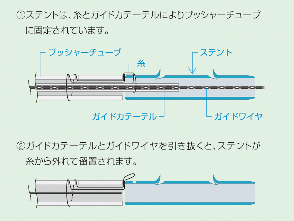 ディスポーザブル プレローデッド胆管ステント QuickPlace V