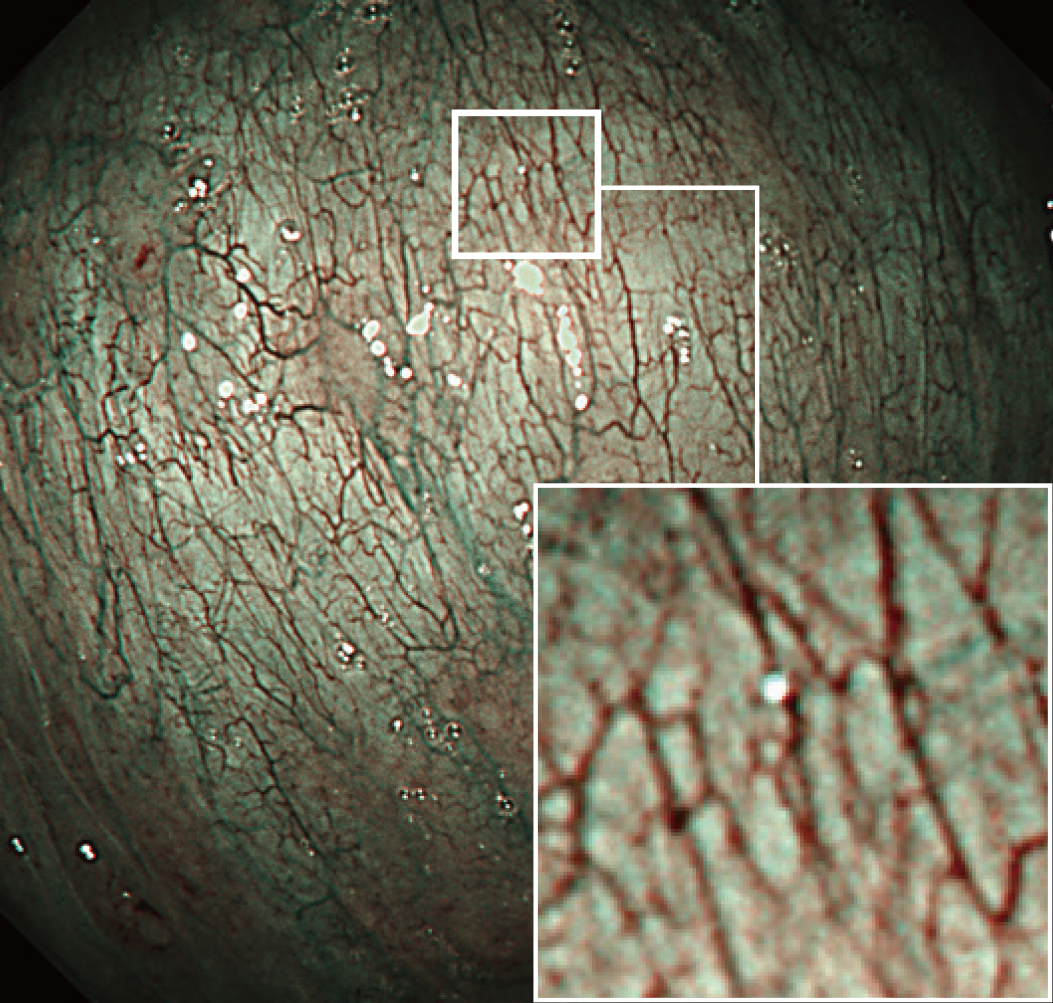 オリンパス：上部消化管汎用ビデオスコープGIF-1200N　NBI画像