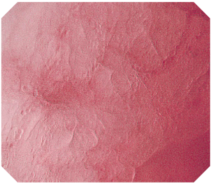 オリンパス：大腸ビデオスコープ  CF-H290ECI　EC-NBI観察　非腫瘍（大腸）