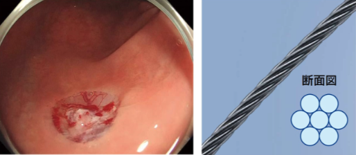 オリンパス：ディスポーザブル高周波スネア SnareMaster Plus　コールドカットによる切除面