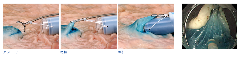 オリンパス：下部消化管ESD時のFlexLifterによる効率的なトラクション