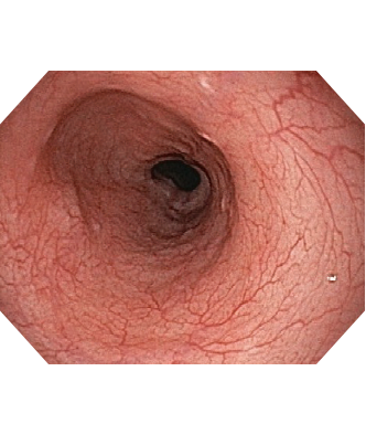 オリンパス：内視鏡システム EVIS EXERAⅢ　通常光観察画像