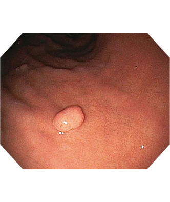 オリンパス：内視鏡システム EVIS EXERAⅢ　通常光観察画像