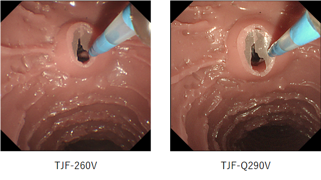 オリンパス:十二指腸ビデオスコープ  TJF-Q290V Q-imageによる高画質化