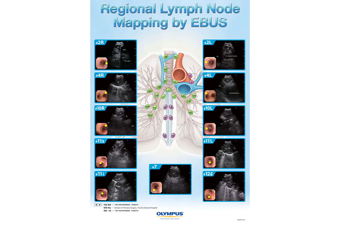 Regional Lymph Node Mapping by EBUS