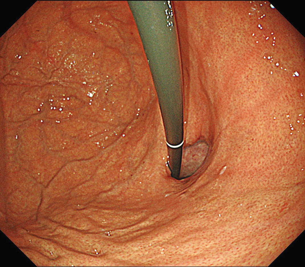 胃体上部小弯~噴門