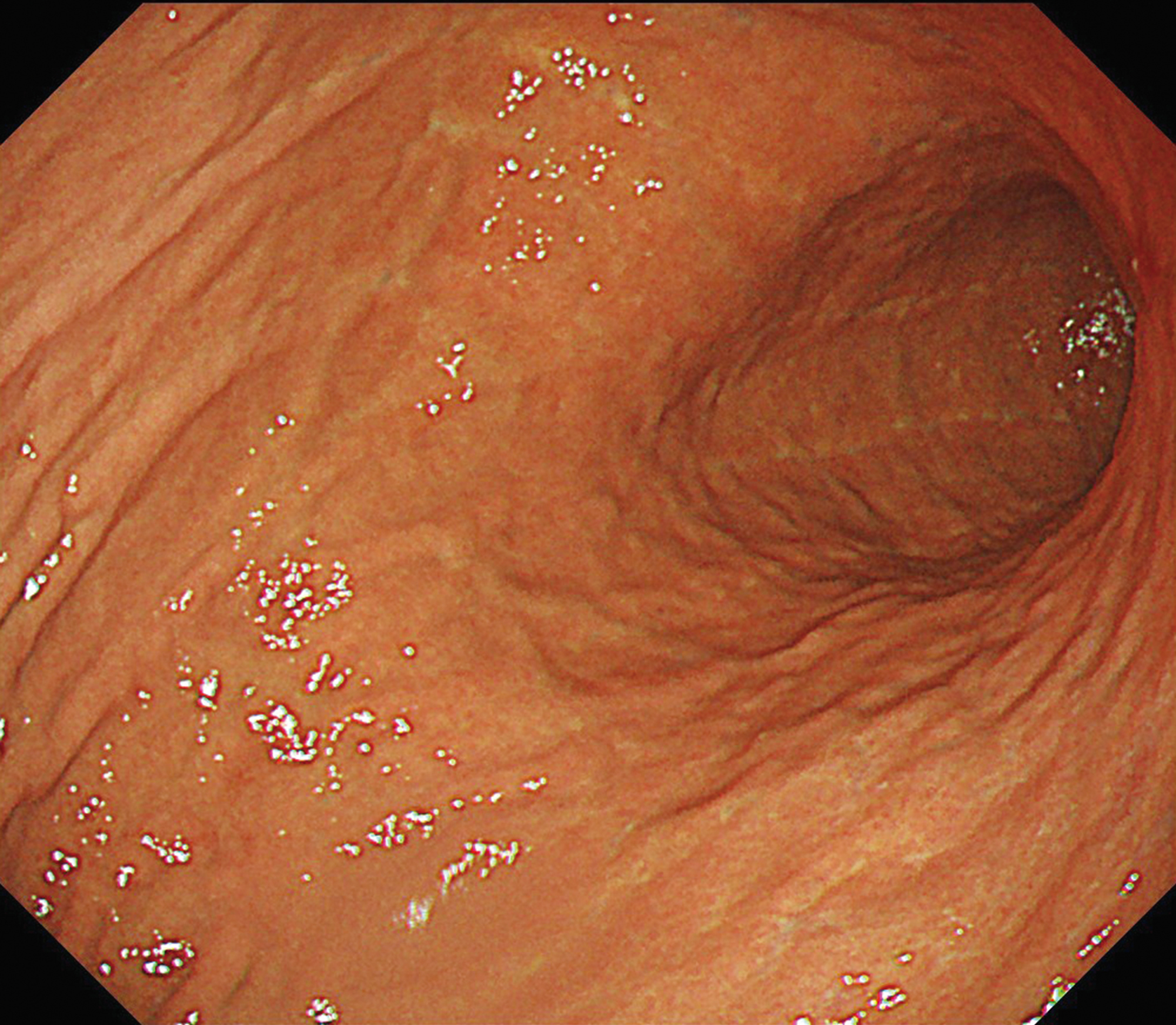 胃体部 見下ろし観察