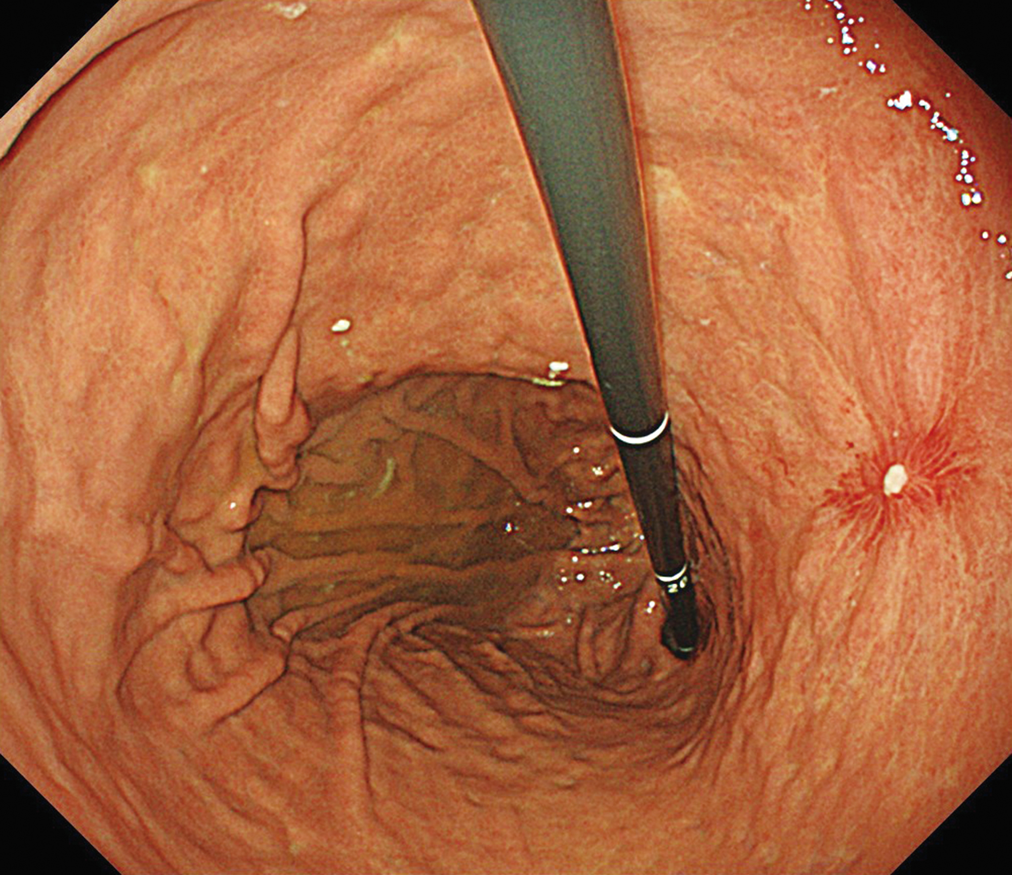 胃体部 見上げ観察 胃潰瘍症例