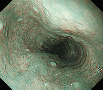 遠景部分において明るい視野が確保できる（病変の例）
