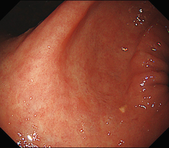 遠景部分において明るい視野が確保できる（粘膜模様の例）