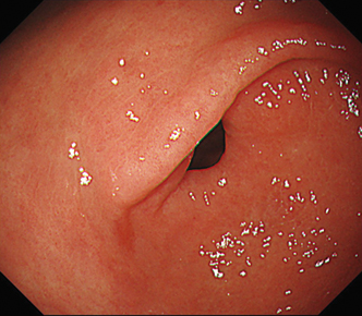 粘膜模様の詳細な観察ができる範囲が広い