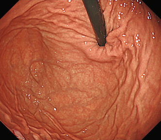 遠景まで明るく粘膜模様の詳細な観察が可能である