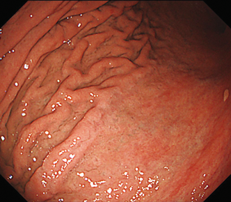 粘膜模様のより詳細な観察が遠景まで可能である
