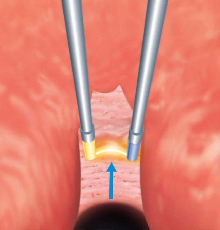 ➁12時・5時・7時方向の切開