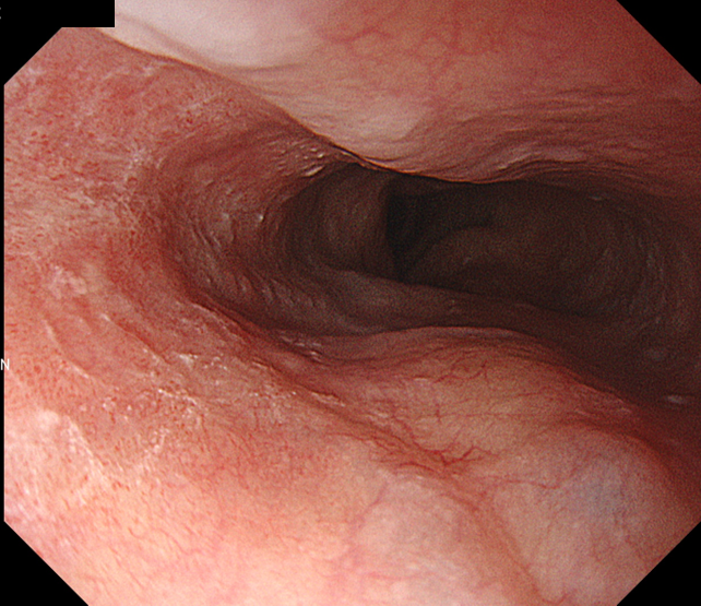 図1 WLI 食道病変