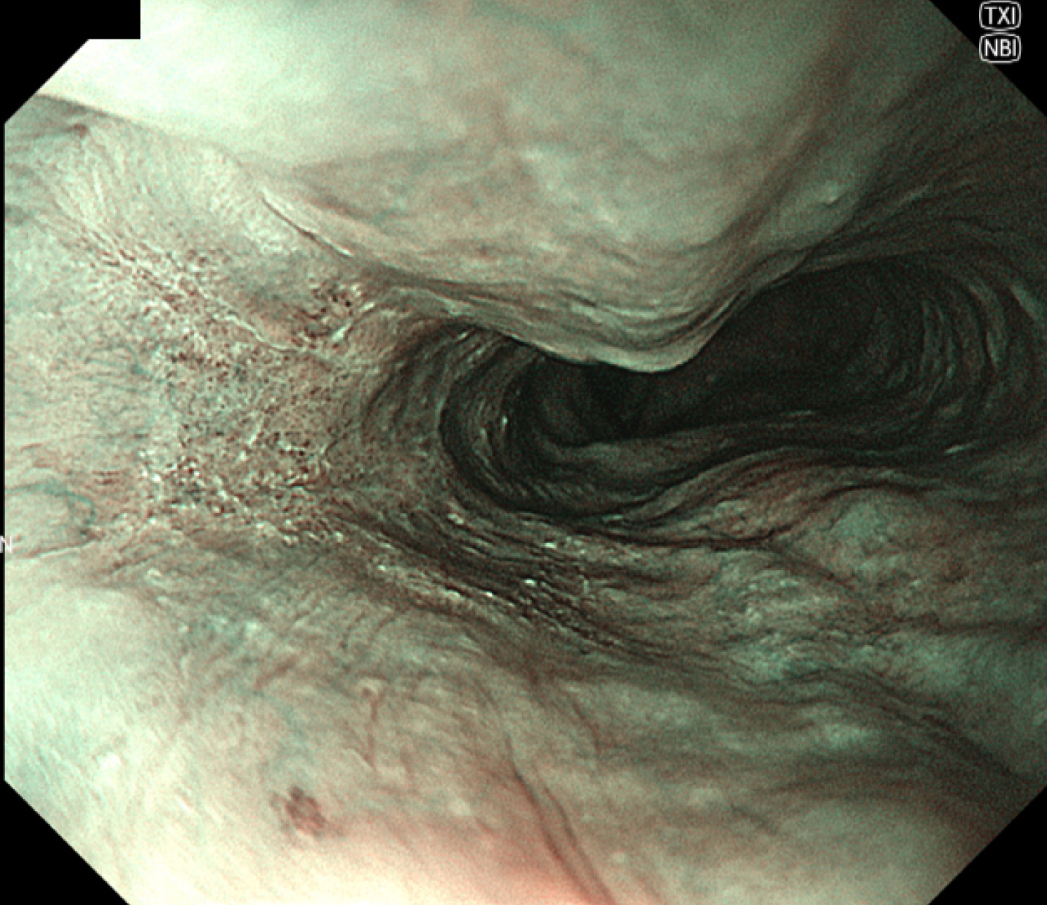 図2　NBI-TXIモード食道病変
