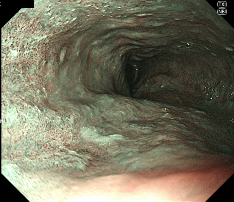 図3 TXI　近接食道病変