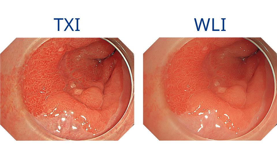 オリンパス：内視鏡システム EVIS X1