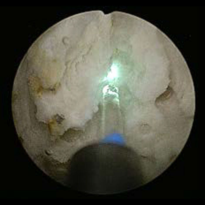 膀胱結石（550μm、2.0（J）ｘ9Ｈｚ）