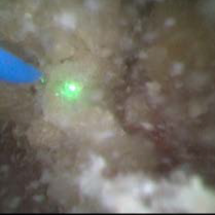 図X/腎結石（150μm、0.8（J）ｘ7Ｈｚ）