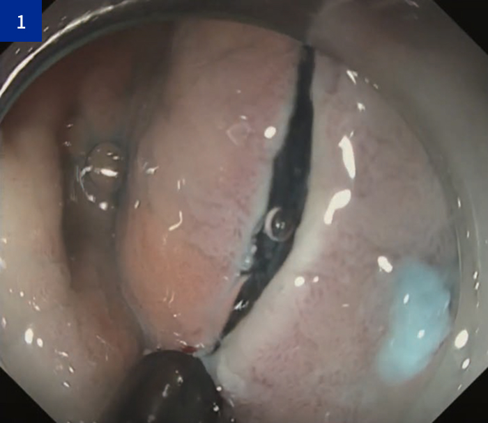 全周切開 ～トリミング