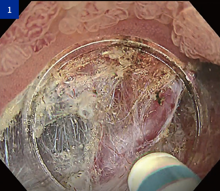 切断と凝固のバランス